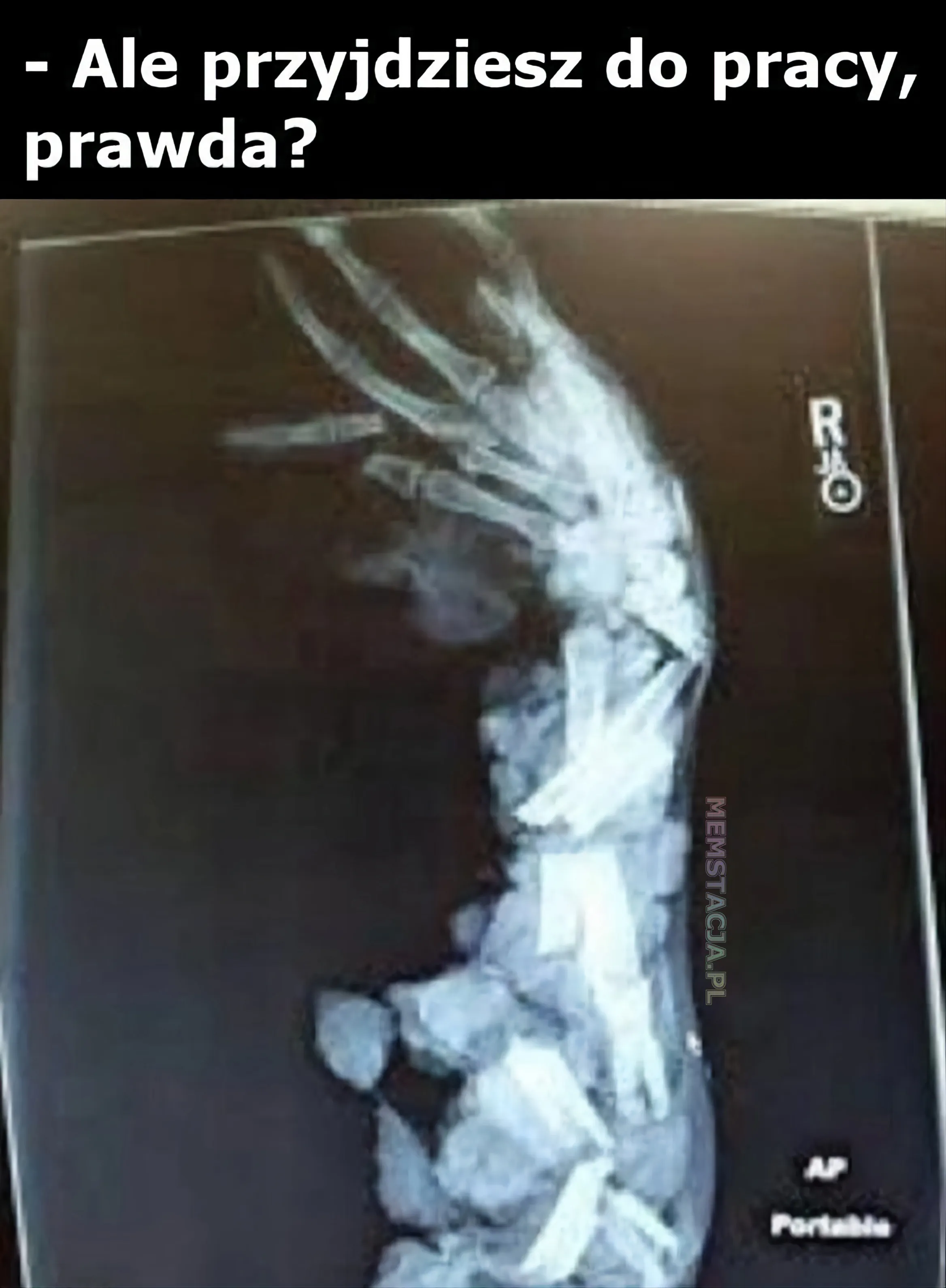 Mem przedstawiający zdjęcie rentgenowskie ręki: 'Ale przyjdziesz do pracy, prawda?'